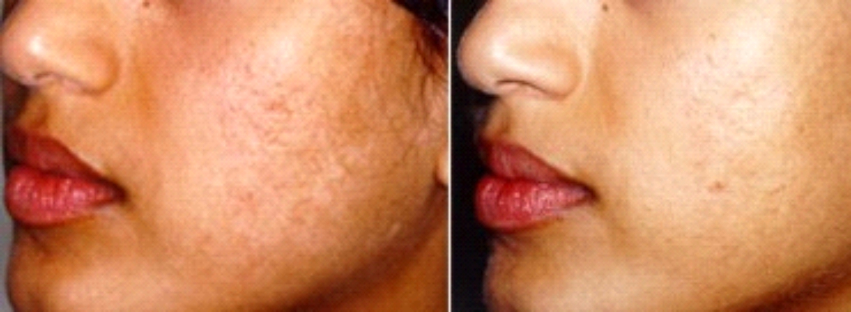 resultat-acne1.jpg
