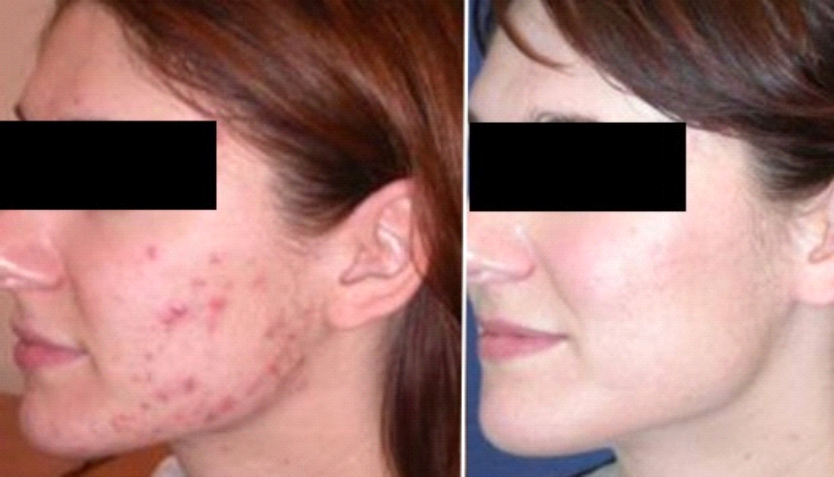 resultat-acne2.jpg